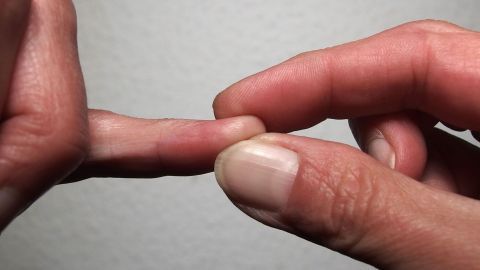 Gegen Schluckauf muss man nicht unbedingt etwas einnehmen. Fingerkuppendrücken hilft. Eine Hand führt einen Druck mit dem Fingerkuppen auf einen anderen Finger aus, um Schluckauf zu bekämpfen.