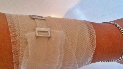 Ein Arm mit Verband und Pflaster, fixiert durch Clips. Der Hintergrund ist neutral, was den Fokus auf die Wundversorgung lenkt.
