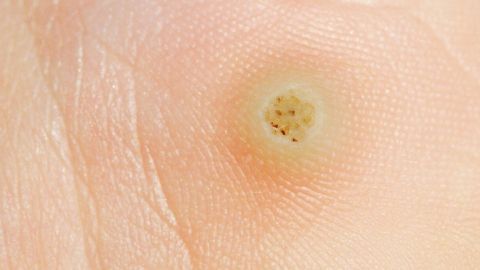 Eine Warze ist auf der Handfläche sichtbar. Sie hat eine gelbliche Farbe mit dunklen Punkten und wirkt erhoben.