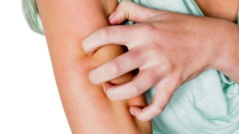 Eine Hand kratzt an einem Oberschenkel, während die Person möglicherweise unter Mückenstichen leidet.