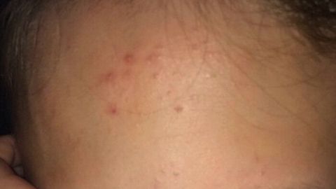 Ein Gesicht mit einigen kleinen, roten Mitessern auf der Stirn, beleuchtet in einem schwachen Licht, zeigt Hautunreinheiten.