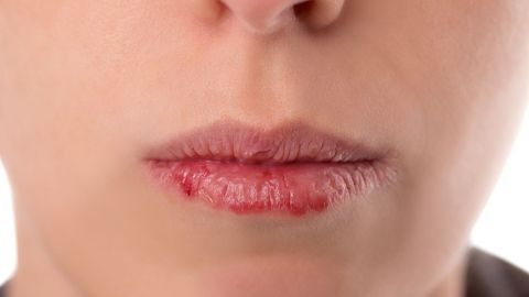 Trockene, rissige Lippen sind sichtbar, was auf Winterpflege und Feuchtigkeit hinweist. Die Haut braucht intensive Pflege.