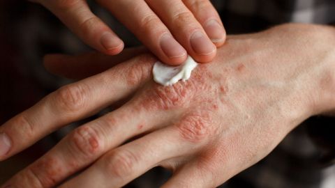 Hände mit Schuppenflechte werden mit einer Creme behandelt, um die Symptome zu lindern und das Hautbild zu verbessern.