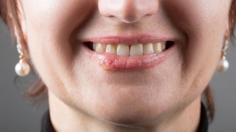 Eine Frau mit lächelndem Gesicht zeigt Symptome von Herpes an der Lippe in einem neutralen Hintergrund.