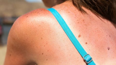 Eine von Sonnenbrand betroffene Schulter ist sichtbar, während die Person mit blauer Trägerbluse am Strand sitzt.