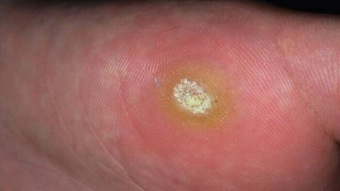 Mithilfe von roter Tinte lästige Dornwarzen endlich loswerden. Jetzt in diesem Tipp mehr darüber erfahren.