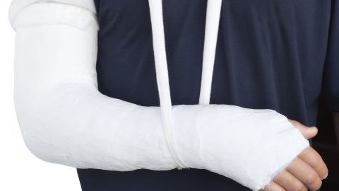 Ein Arm ist in einem weißen Gipsverband eingewickelt, was auf einen jüngst erlittenen Unfall hinweist.