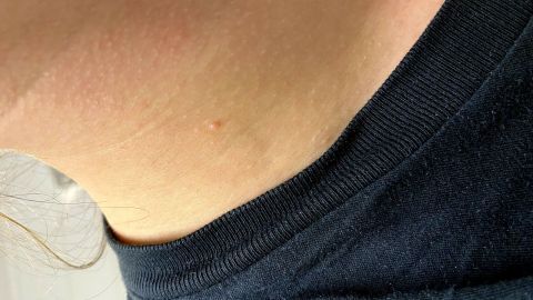 Haut mit kleinen Erhebungen zeigt möglicherweise Warzen, sichtbar an einem Halsausschnitt eines schwarzen T-Shirts.