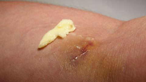 Auf einer Hautstelle liegt Butter, die einen blauen Fleck zu behandeln versucht, während der Arm in einem häuslichen Umfeld ist.