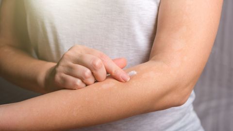 Eine Hand trägt eine Creme auf einen Hautbereich auf, der von Neurodermitis betroffen ist, in einem hellen Raum.