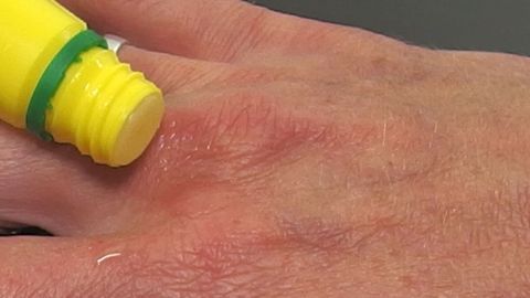 Zur Linderung des Juckreizes bei Mückenstichen hilft Zitronensaft. Auf einer Hand wird Zitronensaft auf einen Mückenstich aufgetragen, um Juckreiz zu lindern.