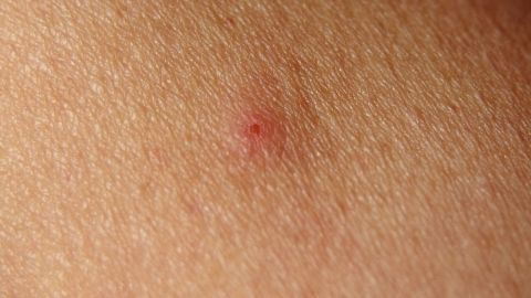 Ein einfacher Trick gegen den Juckreiz von Mückenstichen: Zerdrücke eine Aspirin-Tablette mit etwas Wasser und trage den Brei auf den Stich auf. Die entzündungshemmende Wirkung lindert Symptome schnell und effektiv. Rote Schwellung auf Haut zeigt Mückenstich; Hautoberfläche ist deutlich sichtbar im Nahaufnahme-Kontext.