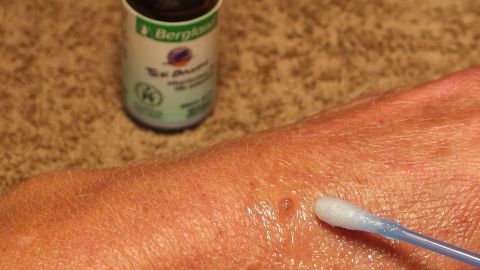 Ein Finger mit einem Wattestäbchen trägt Teebaumöl auf eine Warze auf der Hand auf, während eine Flasche Teebaumöl im Hintergrund steht.