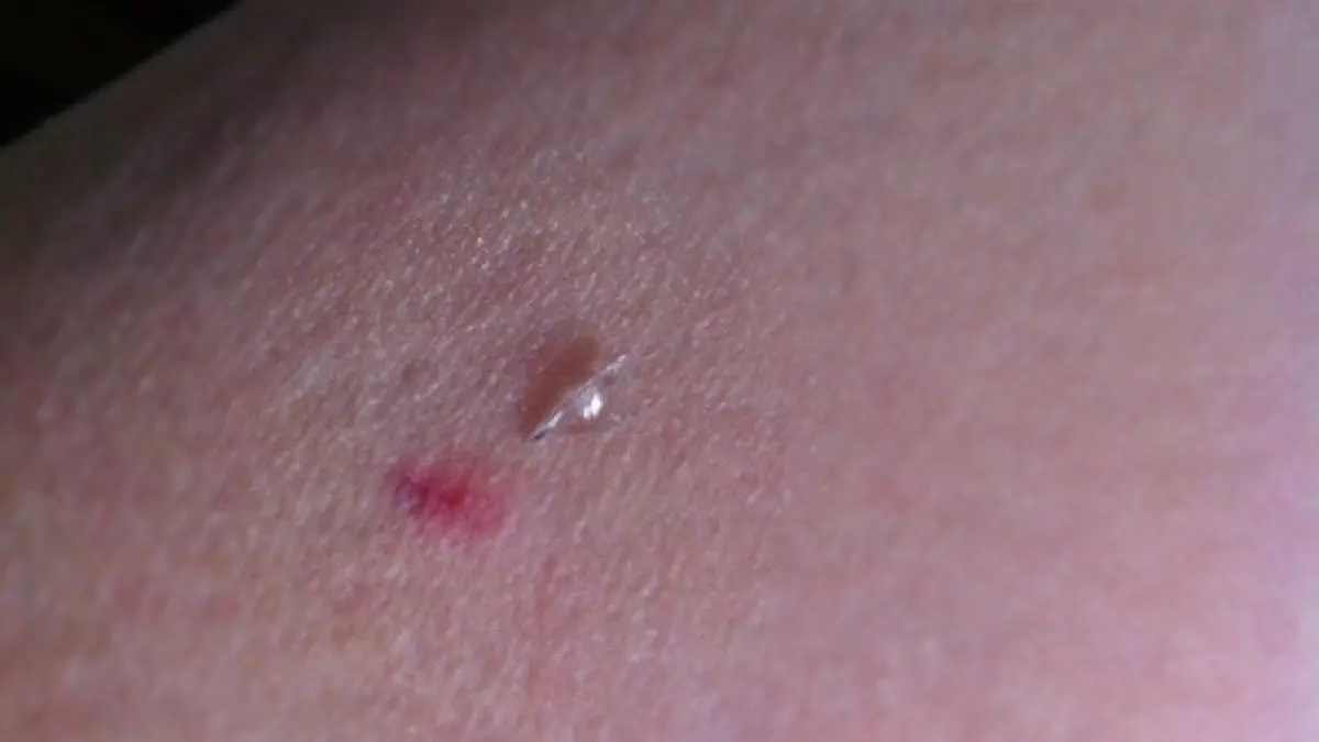 Ein Hautausschlag zeigt einen kleinen Splitter, der aus der Haut herausragt, auf einer menschlichen Hautoberfl&auml;che.