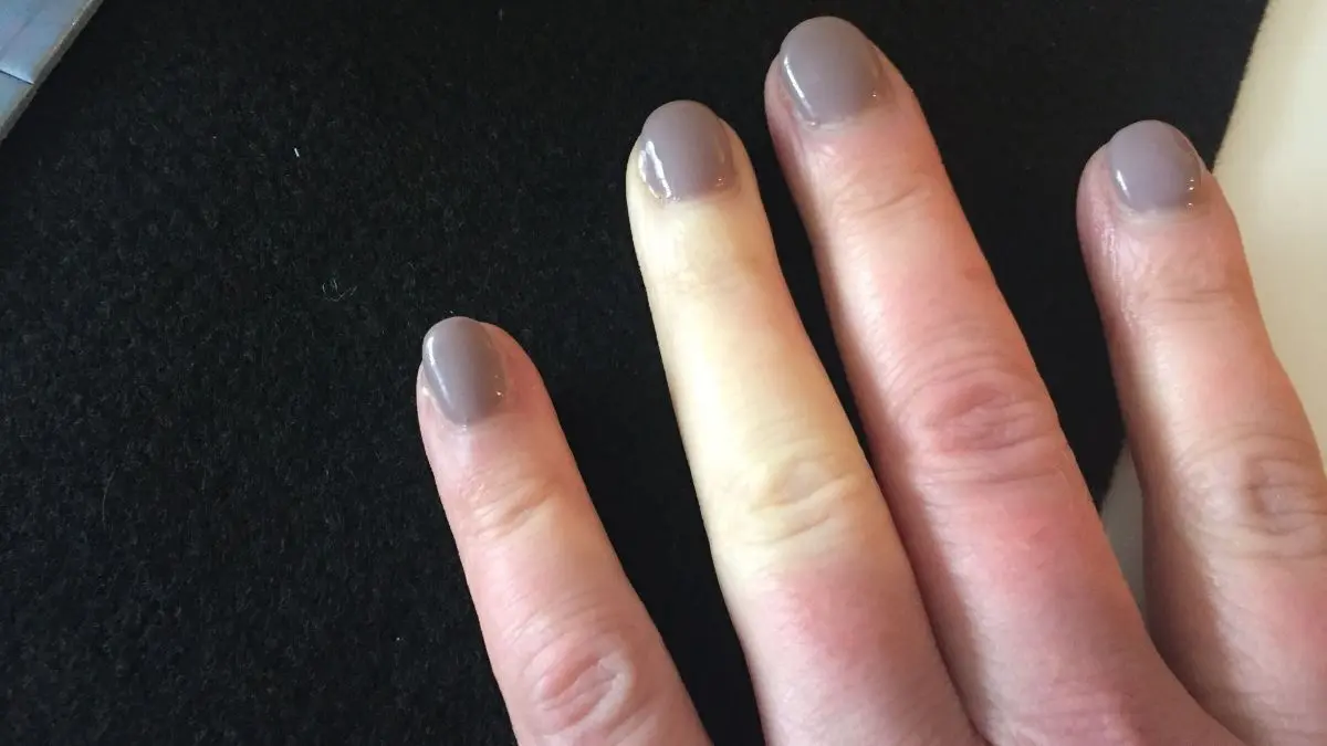Helle, gef&uuml;hllose Finger zeigen eine blass-wei&szlig;e F&auml;rbung auf dunklem Untergrund, was auf das Raynaud-Syndrom hindeutet.
