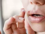 Herpes - die Kombi machts!