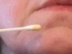 Propolis gegen Pickel im Gesicht