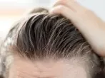 Schnell fettendes Haar