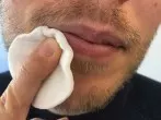 Herpes bekämpfen - extrem aber wirksam