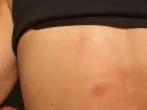 Aspirin gegen Wespenstiche