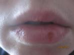 <strong>Isopropyl</strong>-Alkohol gegen Lippenherpes