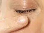 Fremdkörper aus dem Auge entfernen