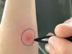 Kugelschreiberkreise bei Stichen