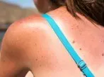Sonnenbrand behandeln: 3 Tipps zum Schmerzen lindern