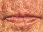 Rauhe und schmerzende Lippen
