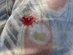 Salz gegen Blutflecken