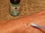 Warzen entfernen mit Teebaumöl