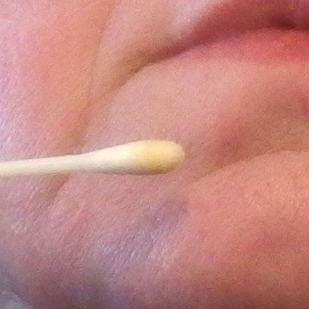 Propolis gegen Pickel im Gesicht