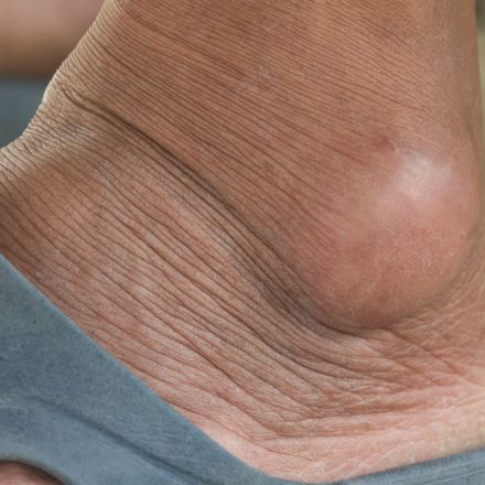 Überbein (Ganglion) wegbekommen