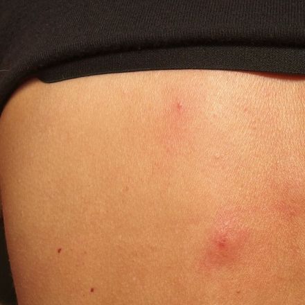 Aspirin gegen Wespenstiche