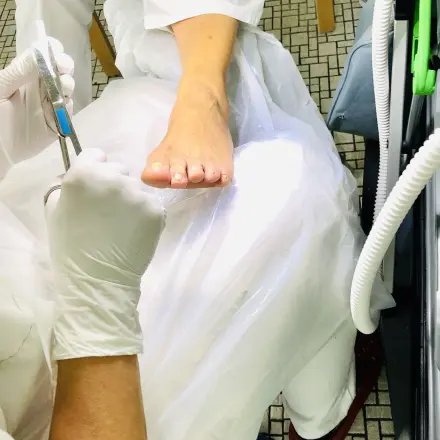 Warze nach 4 Jahren endlich weg