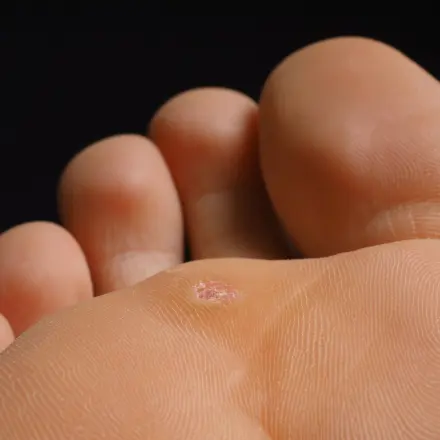 Dornwarzen am Fuß entfernen