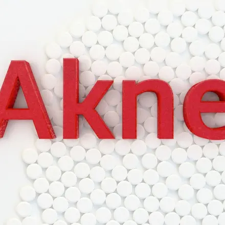 Schwere Akne loswerden - langfristig