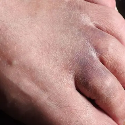 Gefrorenes Küchenhandtuch gegen blaue Flecken