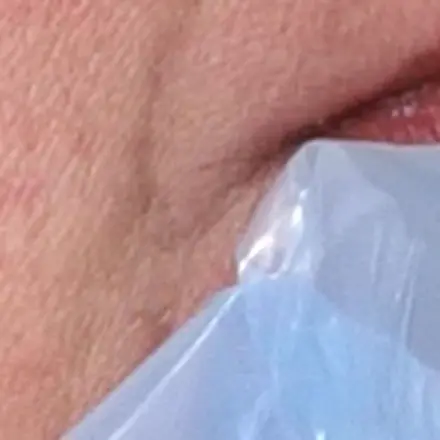 Kälte gegen Herpes