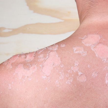 Achtung UV: Die 7 besten Tipps gegen Sonnenbrand