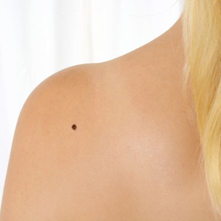 ABCDE-Regel: Woran erkenne ich einen möglichen Hautkrebs?