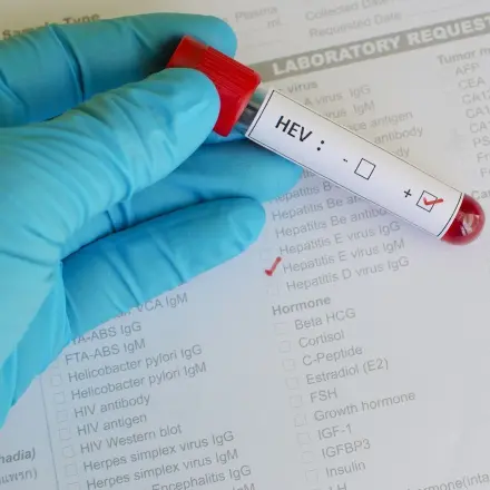 Hepatitis E durch Fleischprodukte: Wie groß ist das Risiko?