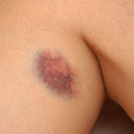 Was tun gegen blaue Flecken?