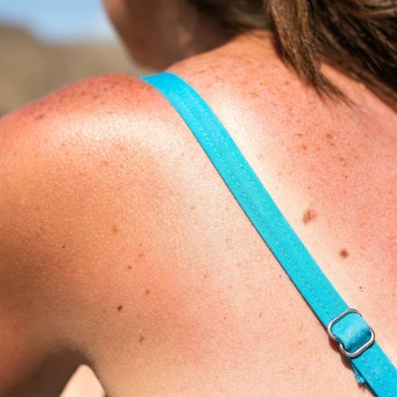 Sonnenbrand behandeln: 3 Tipps zum Schmerzen lindern