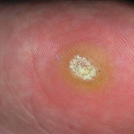 Dornwarzen loswerden mit roter Tinte