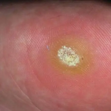 Dornwarzen loswerden mit roter Tinte