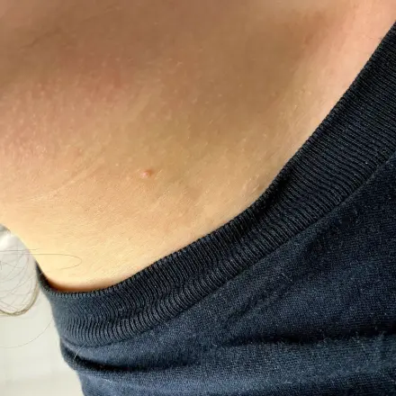 Homöopathisches Mittel gegen Warzen aller Art