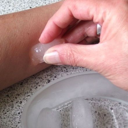 Mückenstiche - Soforthilfe