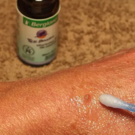 Warzen entfernen mit Teebaumöl