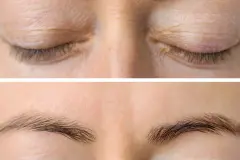 Was tun bei Schlupflidern?